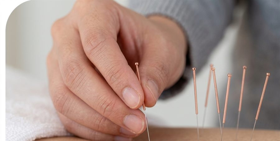 Fine acupuncture needles being placed along a patient's back